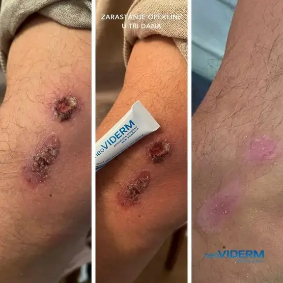 Zarastanje opekline nakon tri dana